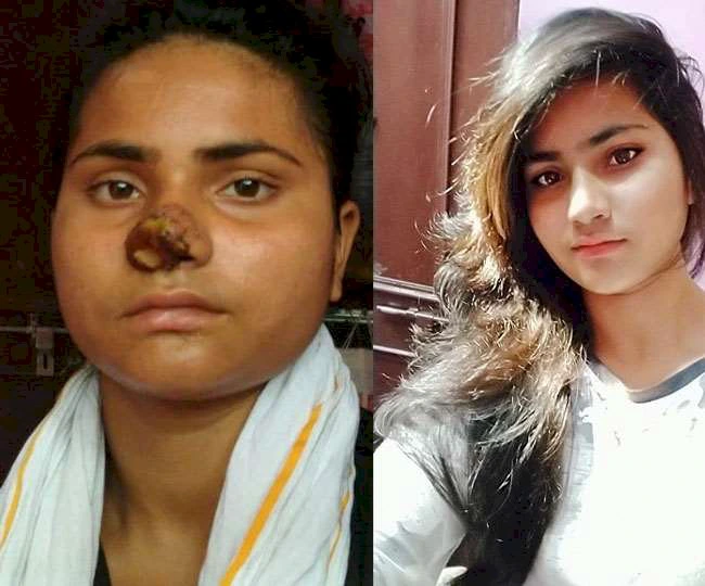 बड़ी बहन ने दांतों से काटी छोटी बहन की नाक, पीड़िता कटा हुआ हिस्सा लेकर पहुंची अस्पताल