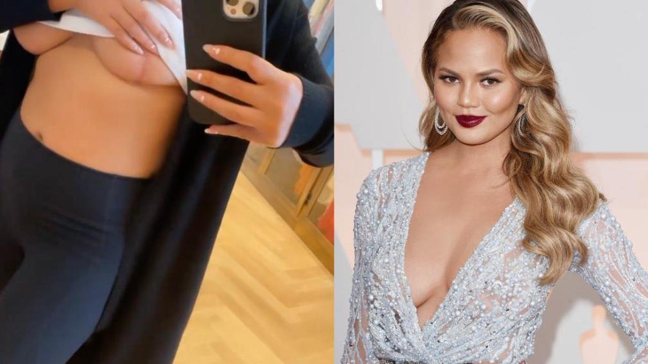 Chrissy Teigen reveals her breast implant removal scars 1 year after  surgery - Opera News