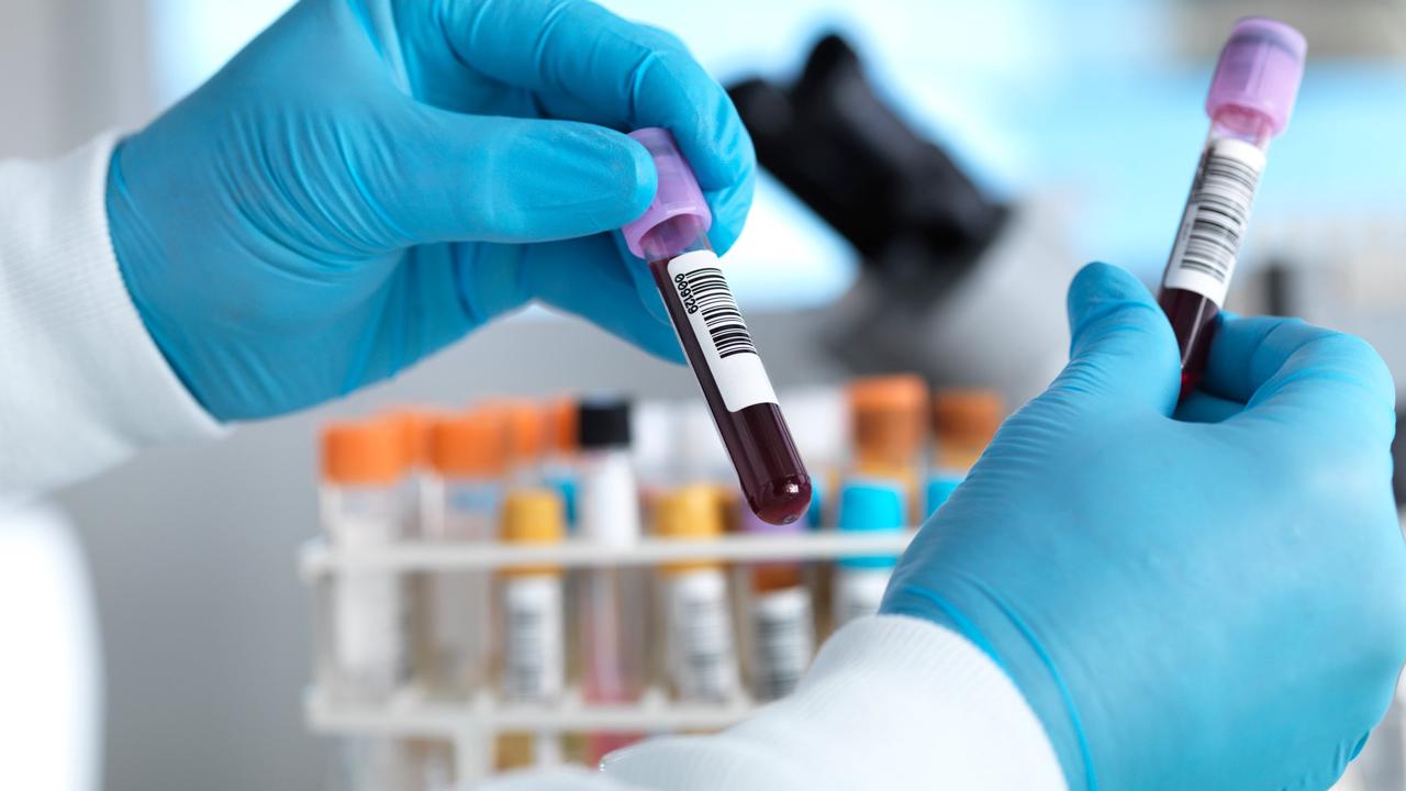 Simple blood test can predict the patients most likely to die from Covid