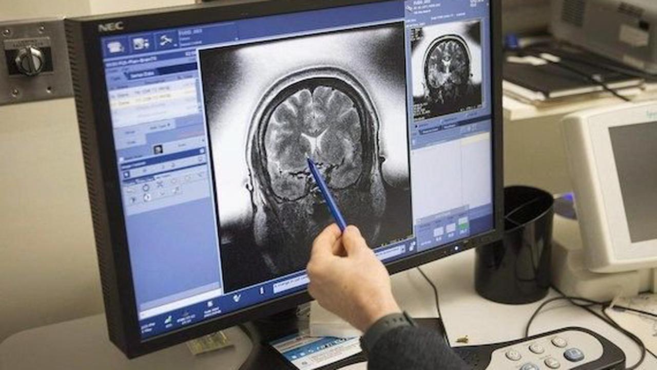 L’imagerie cérébrale pourrait percer les mystères de la maladie d’Alzheimer