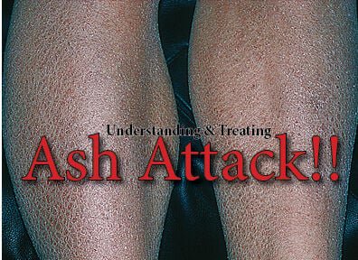 Understanding And Best Treatments For Ashy Skin Opera News