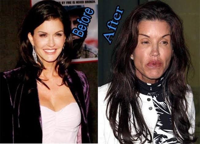 Celebrity Plastic Surgery Gone Wrong Before And After