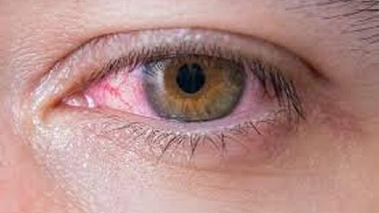 New covid symptom discovered and it affects the eyes