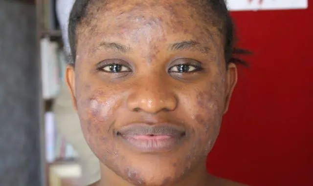 How to get rid of pimples following simple procedures.