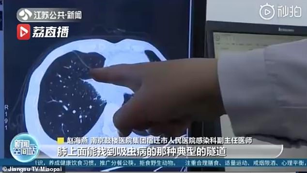 The patient was later diagnosed with paragonimiasis, a food-borne parasitic infection caused by lung fluke. The picture shows a medic pointing out the serious, line-shaped infections on the man's lungs on CT scans