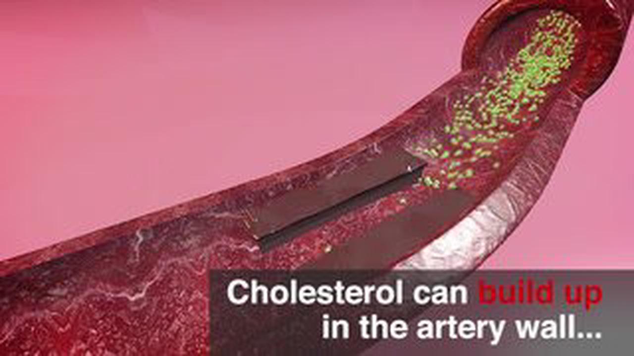 High cholesterol can be inherited - four physical signs 'when extra cholesterol builds up'