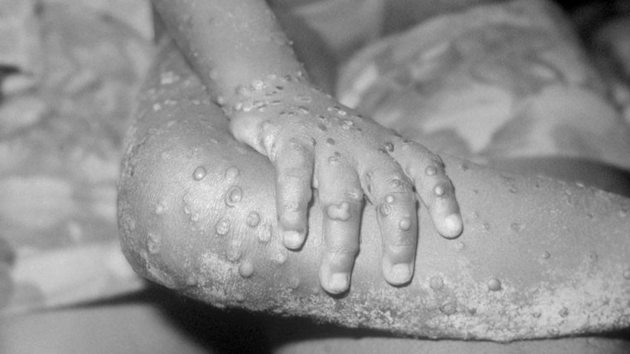 Les experts de la maladie offrent des premières idées sur les raisons pour lesquelles l’épidémie de monkeypox en Europe a gonflé