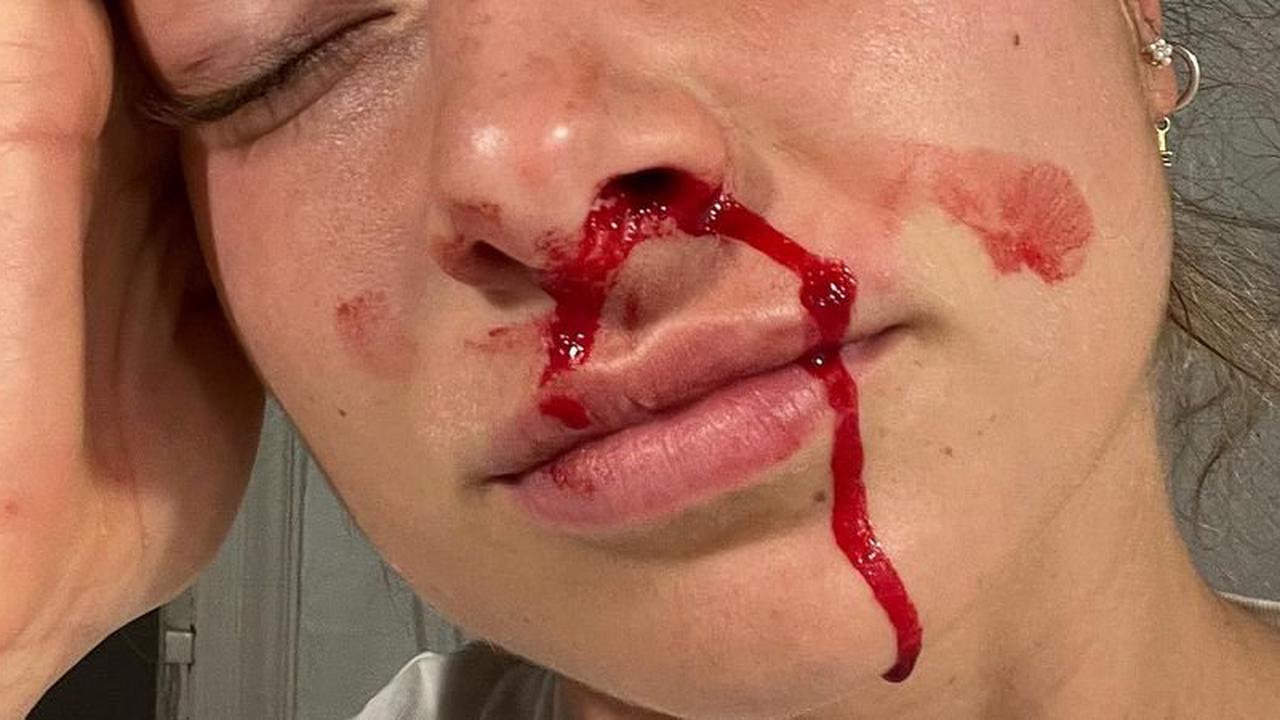 Voller Blut: Moderatorin Lola Weippert schockt Fans mit Foto