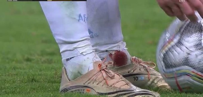 Messi played the second half with his ankle bleeding until the end