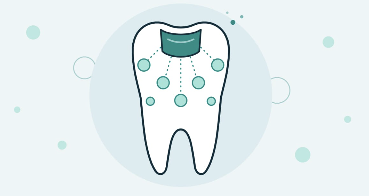 Fluoride-Emitting Fillings May Offer More Than Cavity Repair