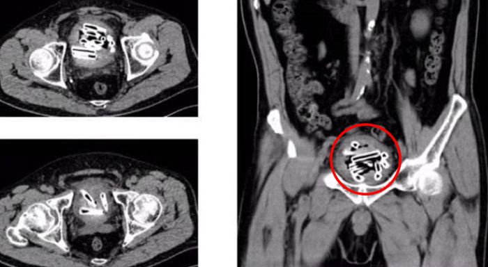 Dokter dibuat terkejut dengan apa yang ditemukannya dalam organ intim pria ini