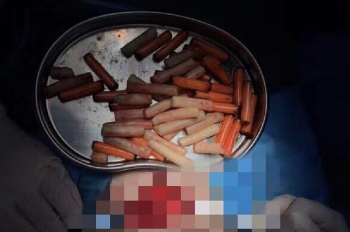 47 tabung karet yang berhasil dikeluarkan dari organ intim pria ini