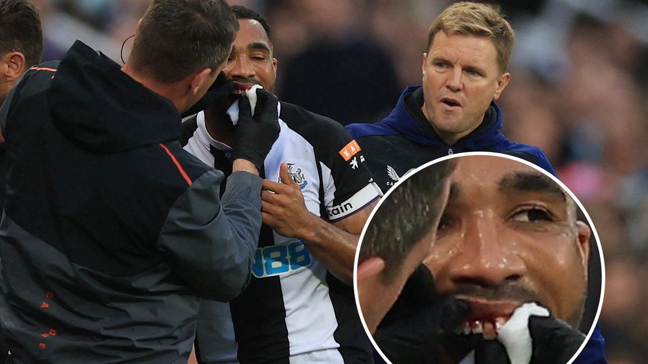 Gruesome moment Callum Wilson's tooth falls out live on Sky Sports after  whack in face during Newcastle vs Arsenal - Opera News