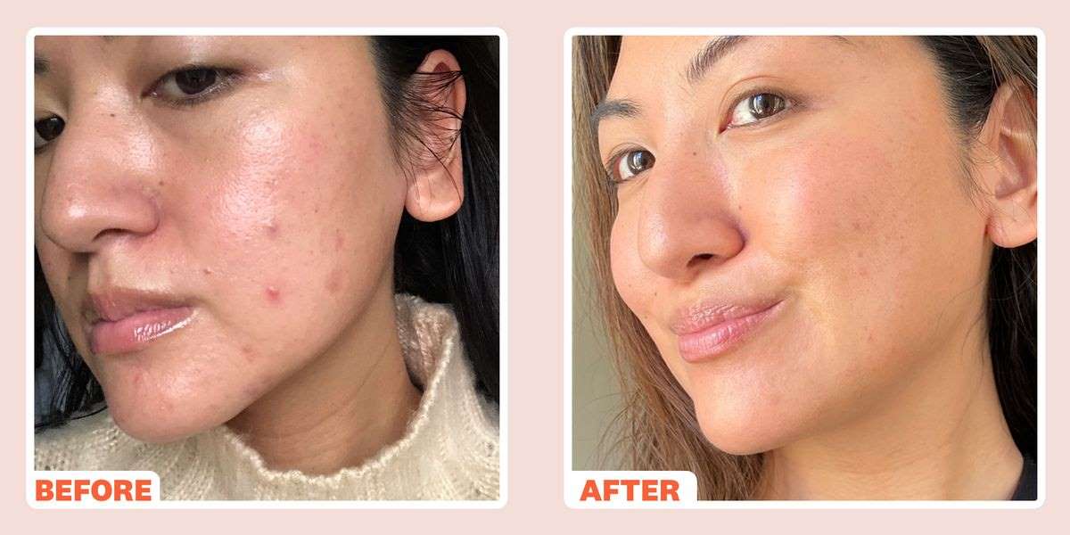 acne personalized treatment
